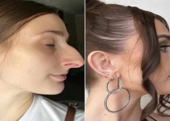جراحة تجميل بـ11 ألف دولار ساعدت امرأة على إنهاء زواجها