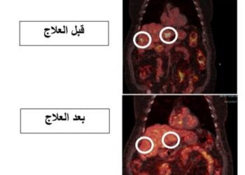إنجاز طبي جديد في مستشفى الملك المؤسس