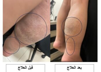 علاج ورم نادر بالأشعة لطفل في مستشفى الملك المؤسس