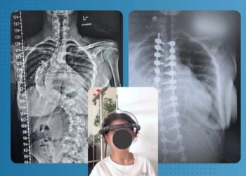 إنجاز طبي جديد في جراحة العمود الفقري بمستشفى حمزة