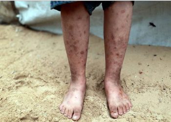 القوارض والأوبئة الجلدية تغزو خيام النازحين في قطاع غزة