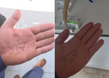 طبيب عراقي يكتب وصفة العلاج على يد مريض بسبب نفاد الورق