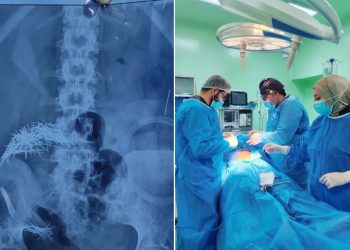 214 إبرة ودبوسا في بطن رجل.. جراحة استثنائية في العراق